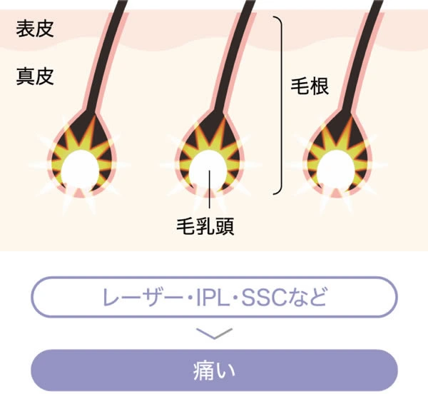 レーザー・IPL・SSC方式イメージ